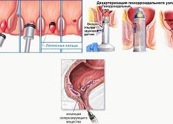 Симптомы и способы лечения геморроя