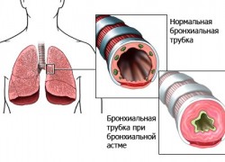 Лечение бронхиальной астмы в Новосибирске